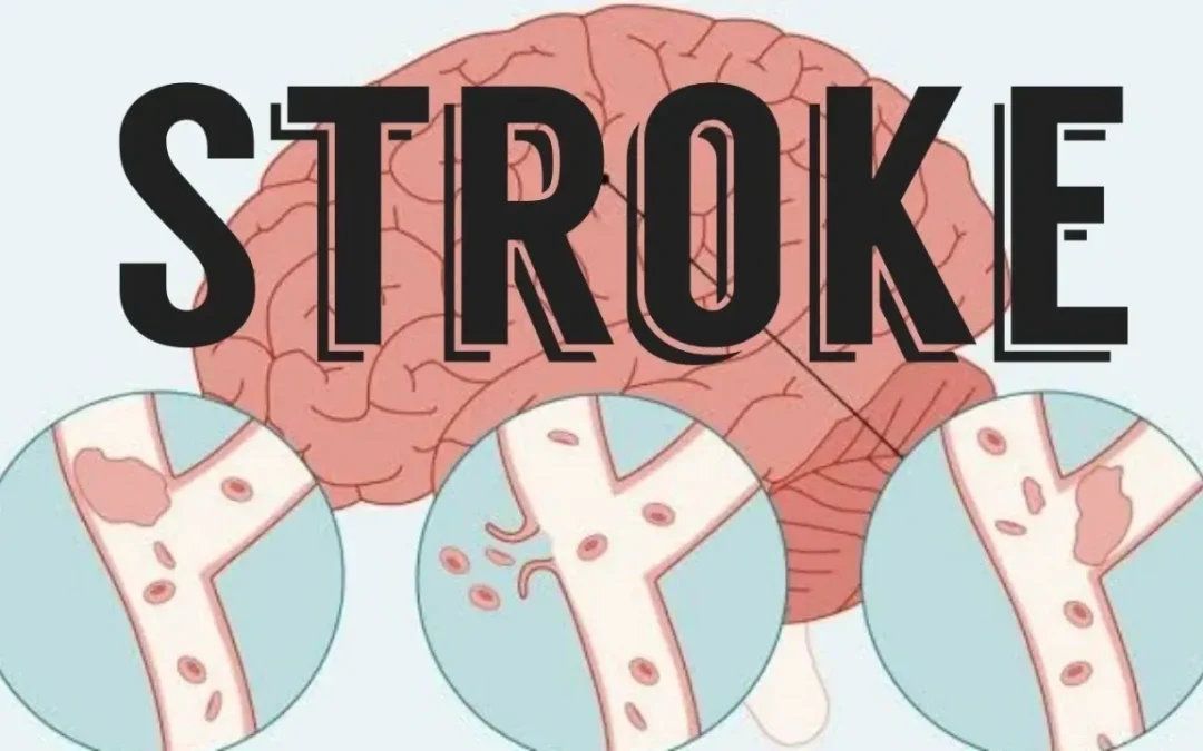 What is a stroke and how can a Biokineticist help you?