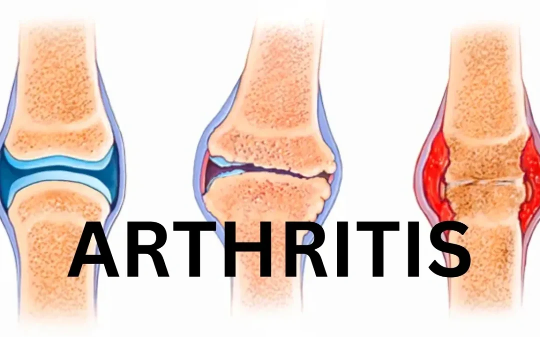 What is Arthritis? And how does Biokinetics help?